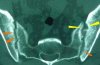 ISG-Arthritis_rheumatica.jpg