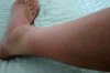 Urticaria_1736.gif