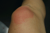 Urticaria_1802.gif