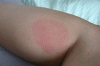 Urticaria_1801.gif