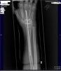 Arthrodese HG r 4tag post op.JPG