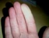 Raynaud081109.JPG