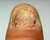 nagelpilz.05.09.11.jpg