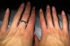Schwellung kleiner Finger.jpg