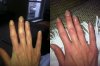 Entzündungen Finger.jpg
