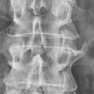 Parasyndesmophyten